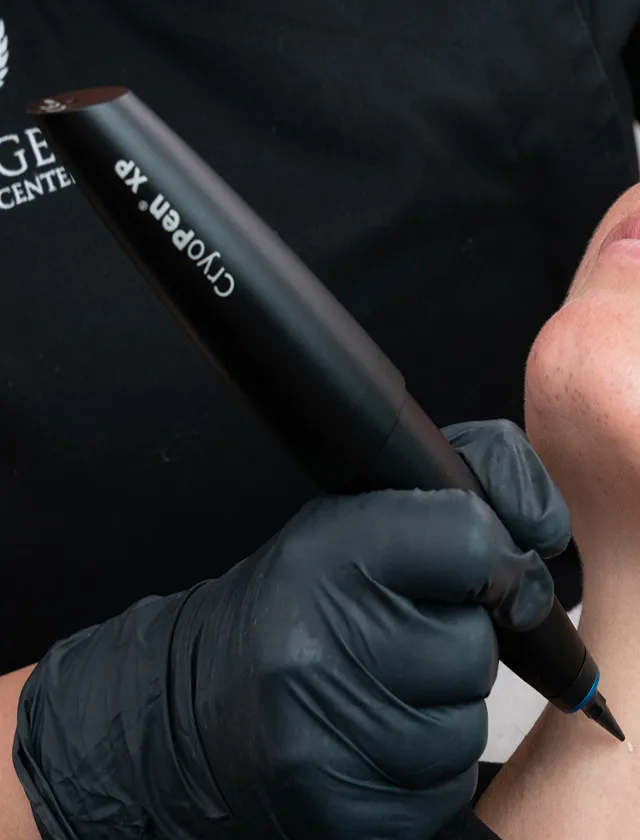 CryoPen behandling