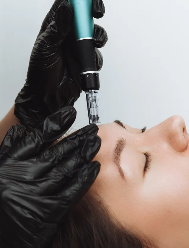 Microneedling i Stockholm Microneedling