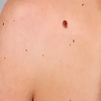 CryoPen för födelsemärken CryoPen för födelsemärken