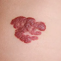 Hemangiom