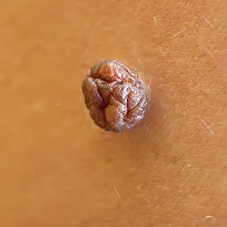 Hudutväxt