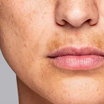 Laserbehandling mot Melasma Laserbehandling mot Melasma