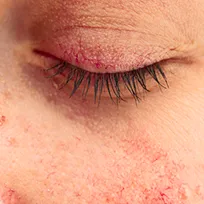 Rosacea runt ögonen Rosacea runt ögonen