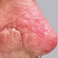 Hudförtjockning vid rosacea Hudförtjockning vid rosacea
