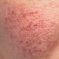 IPL-behandling för Rosacea