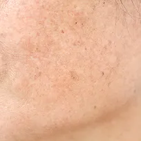 Kemisk peeling mot solskador