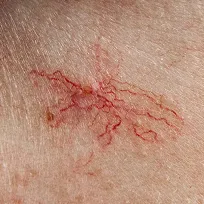 Spider nevus