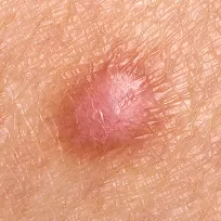Symmetriska fläckar Symmetriska fläckar