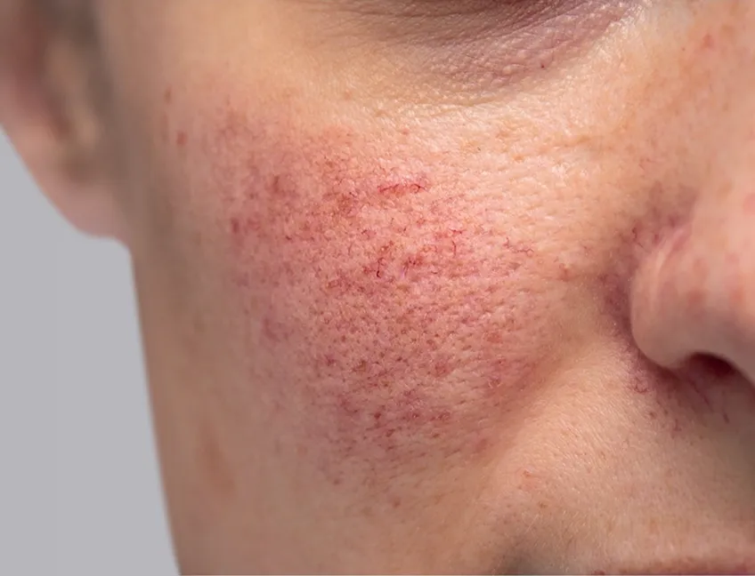 Rosacea Rosacea