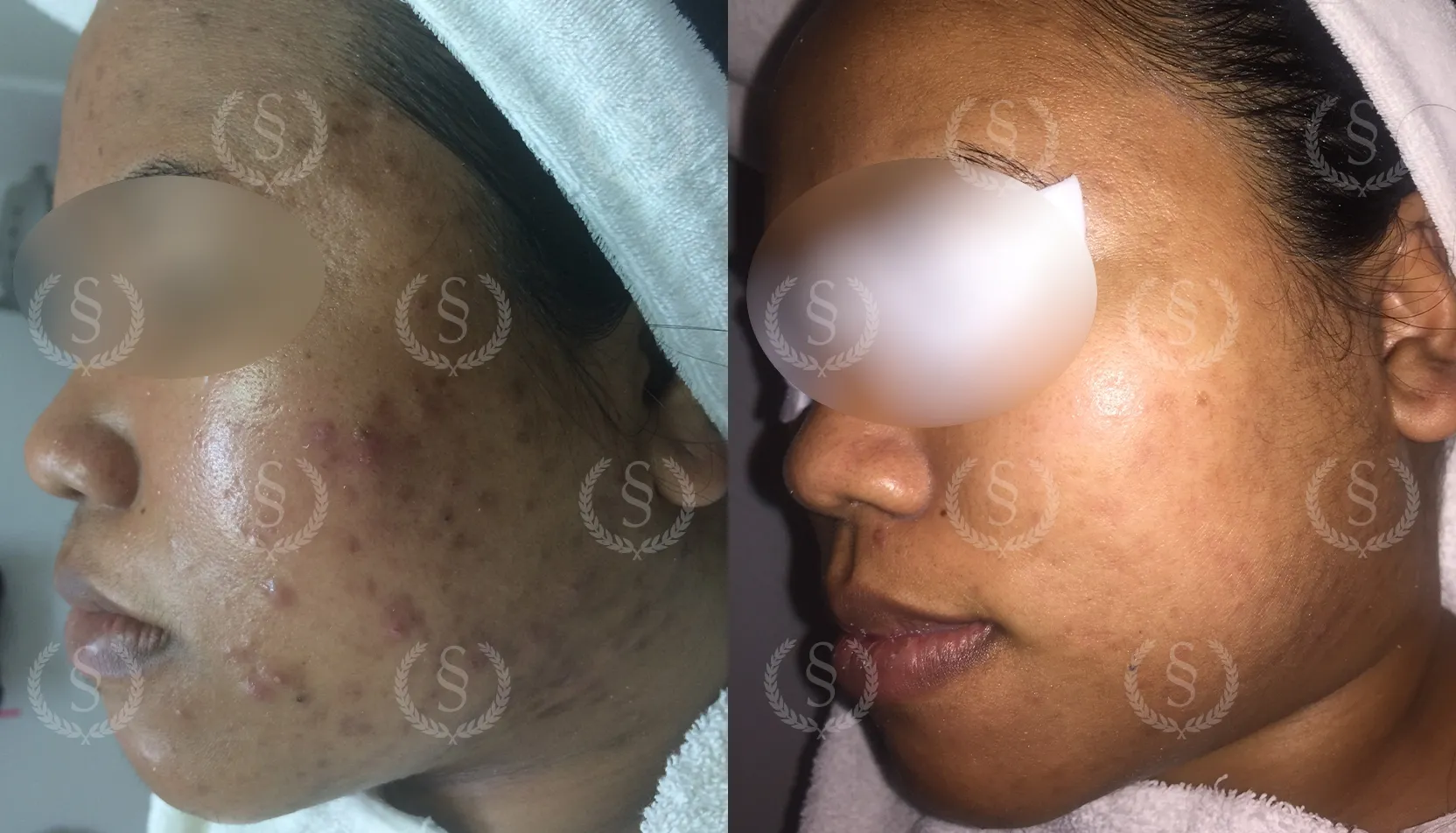 Resultat efter behandling av akne på kind och hals Akne på kind och hals före och efter behandling