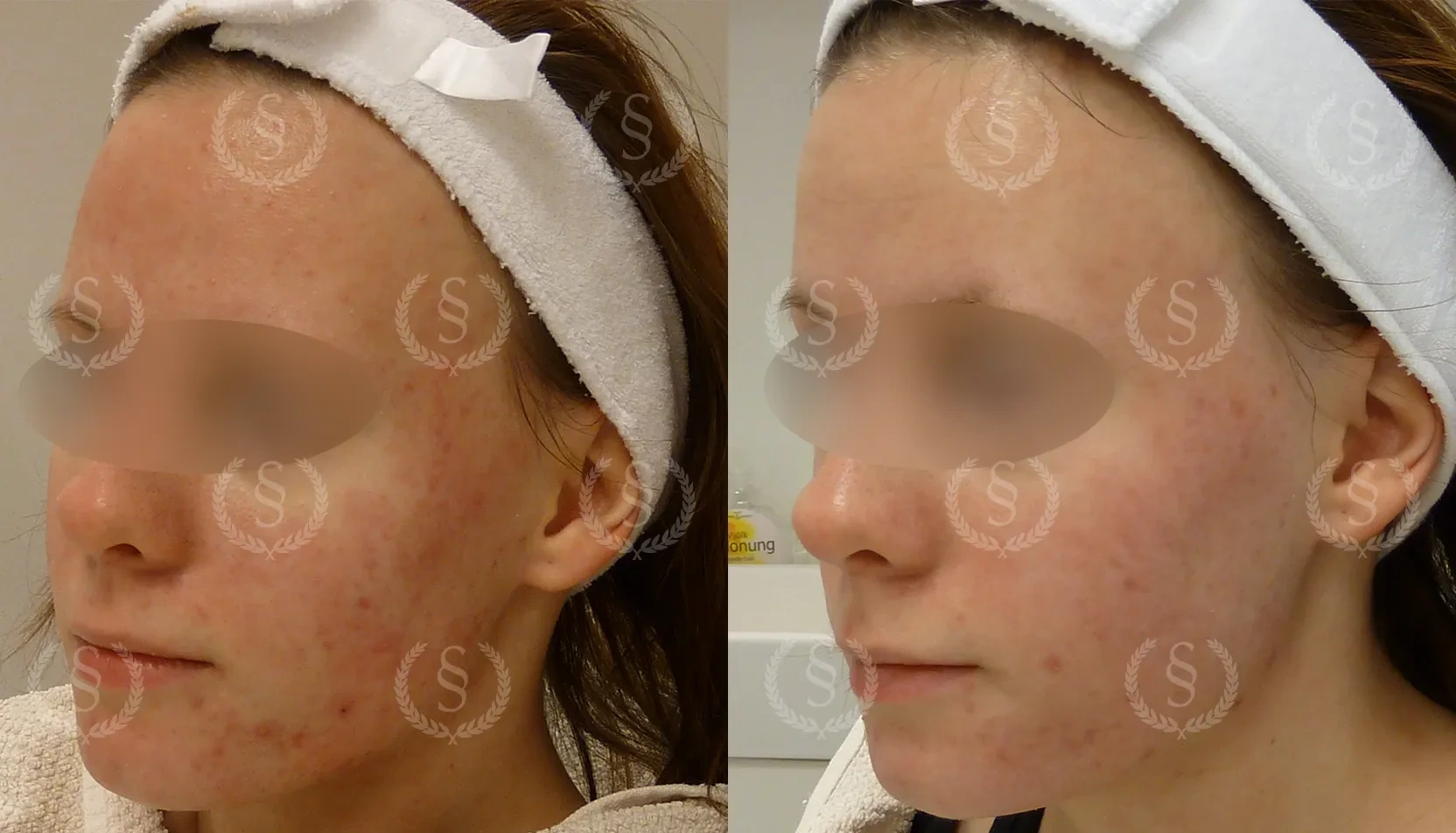 Resultat efter behandling av akne med rodnad Akne med rodnad före och efter behandling