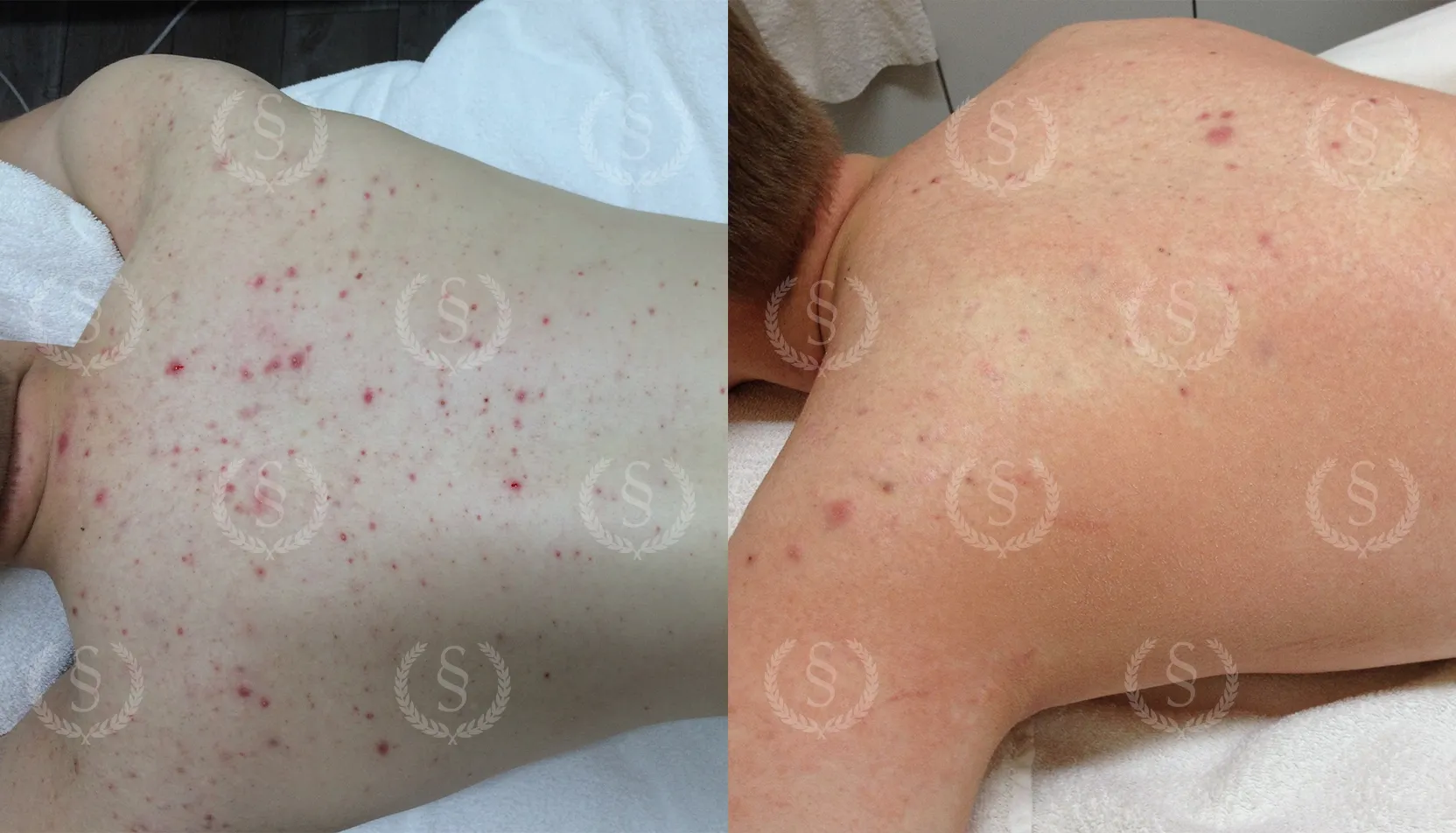 Resultat efter behandling av ryggakne Akne på ryggen före och efter behandling