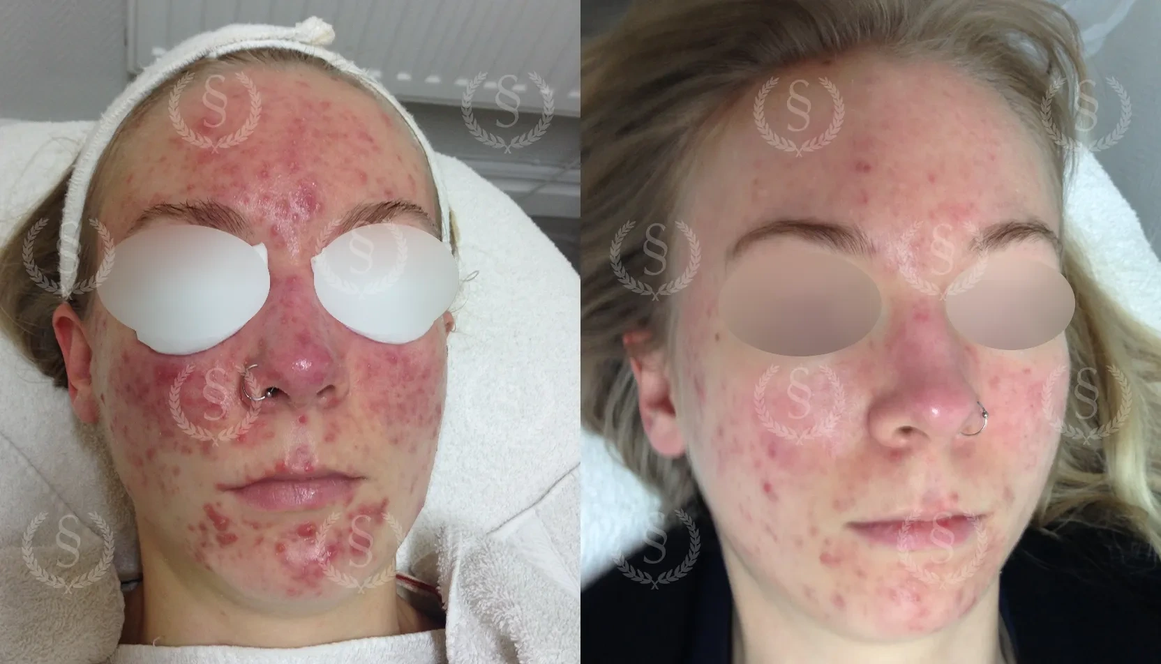 Resultat efter behandling av svår akne Svår akne före och efter behandling