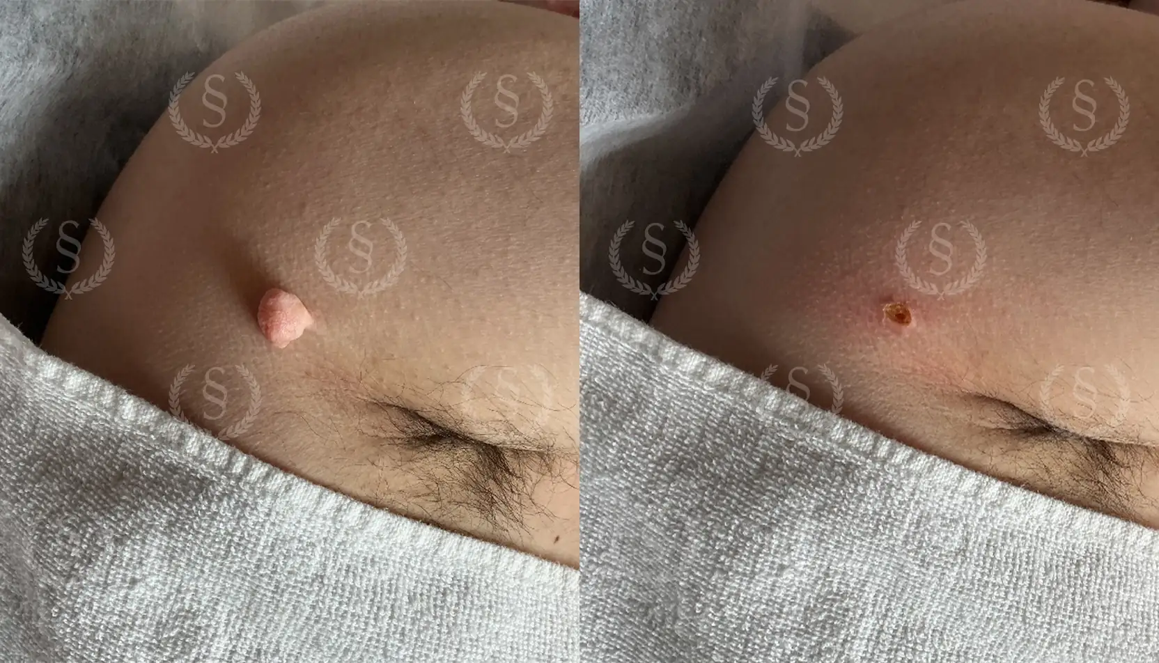 Stor hudförändring på axeln före och efter laserbehandling