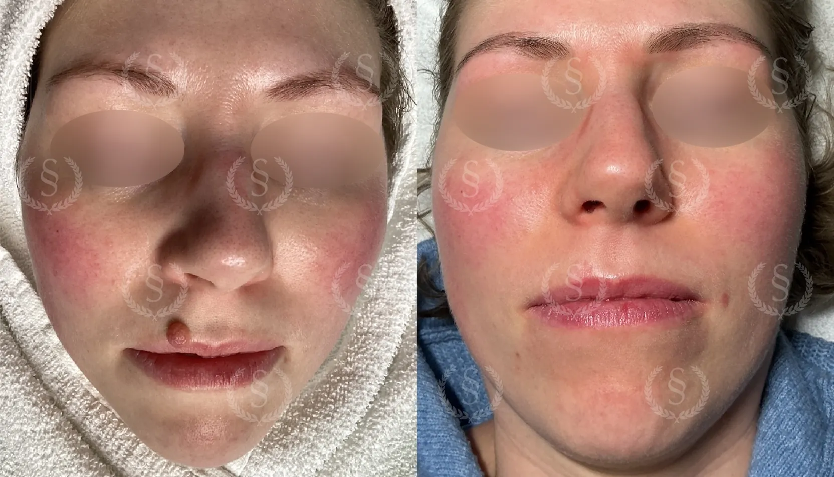 Hudförändring på läppen före och efter laserbehandling