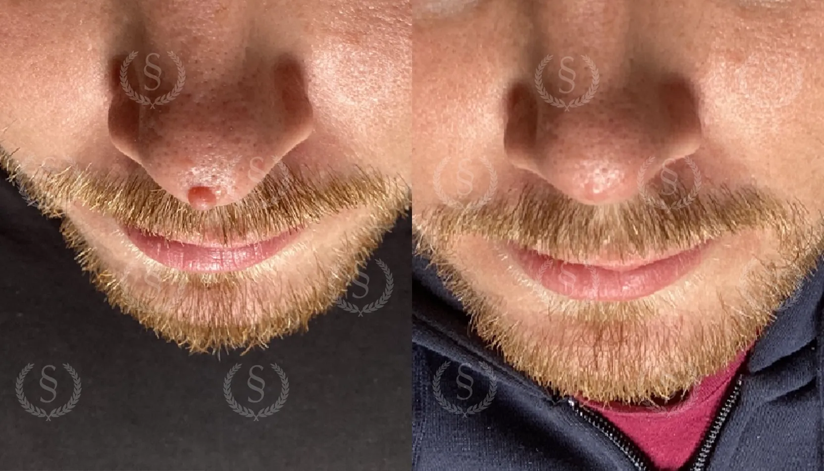 Hudförändring på näsan före och efter laserbehandling