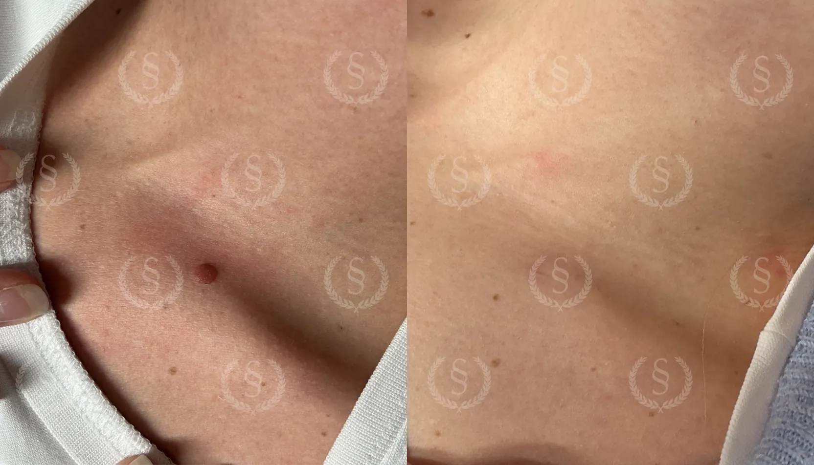 Hudförändring vid nyckelbenet före och efter laserbehandling