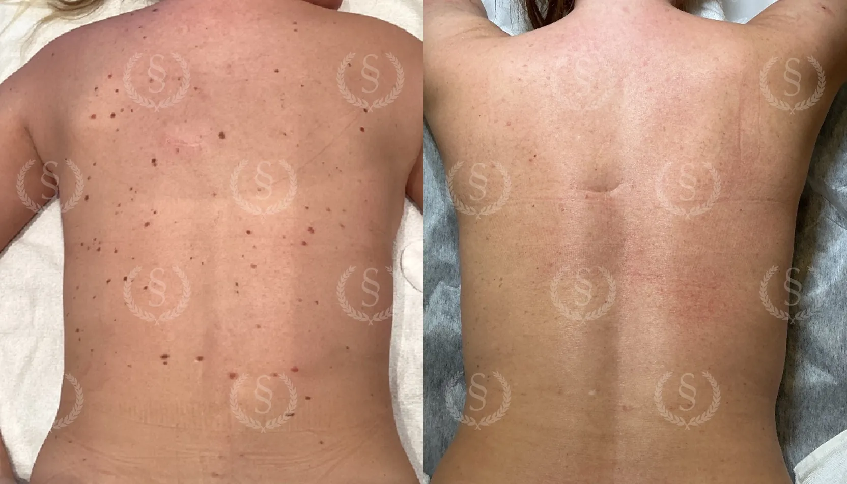 Hudförändring på ryggen före och efter laserbehandling