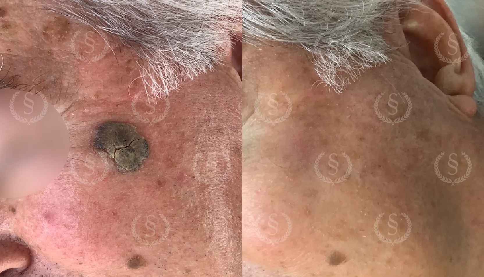 Hudförändring vid tinningen före och efter laserbehandling