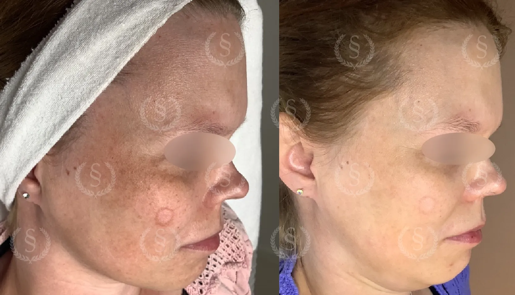 Behandling av pigmentfläckar i ansiktet Pigmentfläckar i ansiktet före och efter behandling