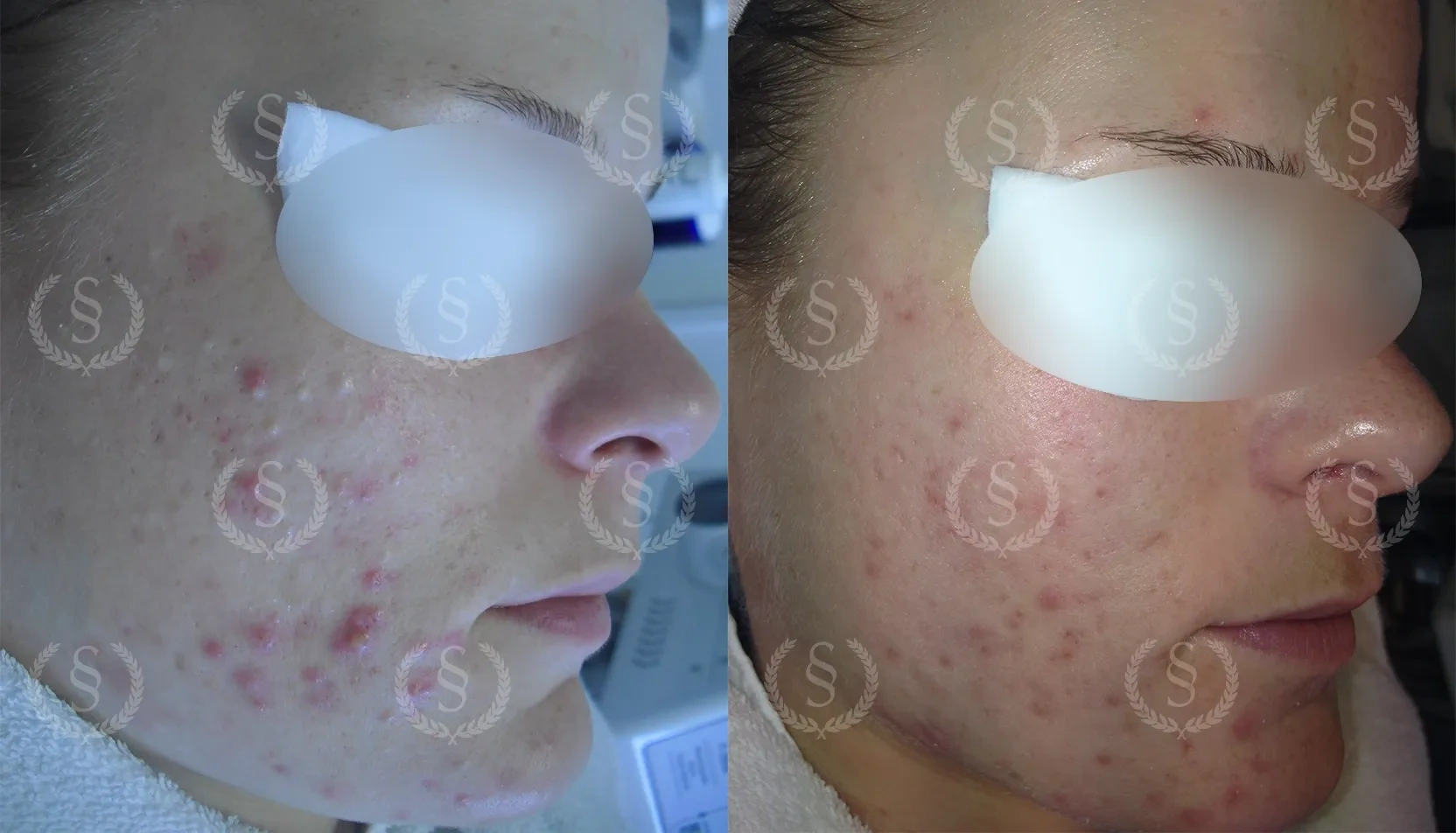 Inflammerad hy med porer före och efter behandling