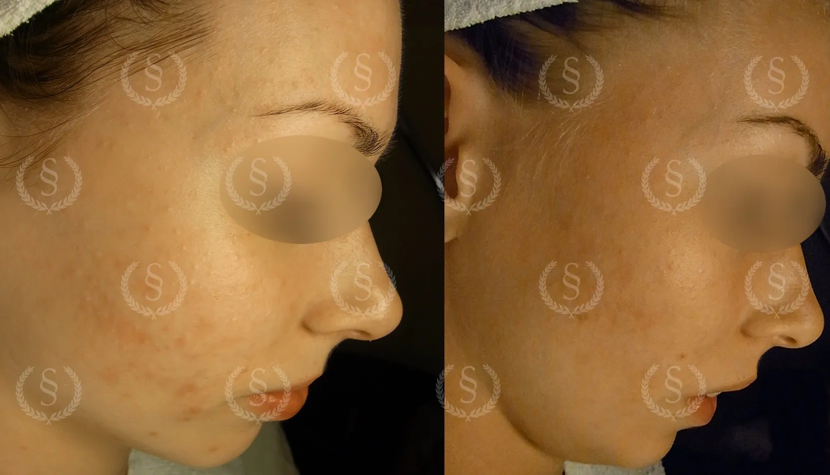 Resultat efter behandling av vita pormaskar Vita pormaskar i ansiktet före och efter behandling