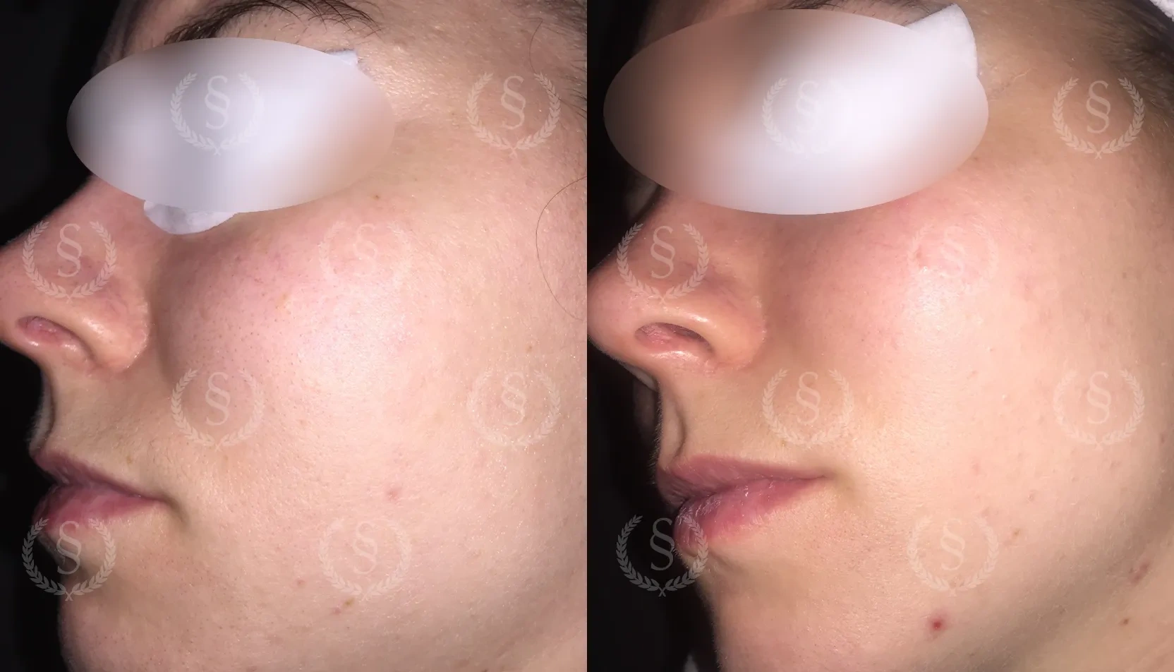 Resultat efter behandling av svarta pormaskar Svarta pormaskar på kind före och efter behandling