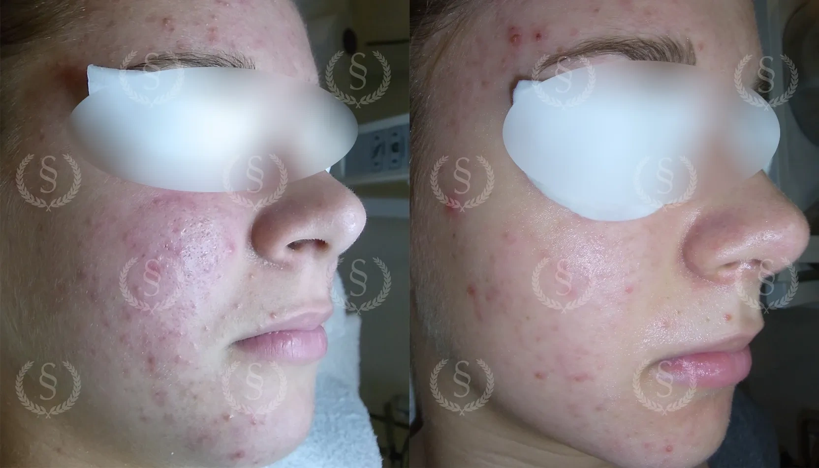 Behandling av många pormaskar Många pormaskar i ansiktet före och efter behandling