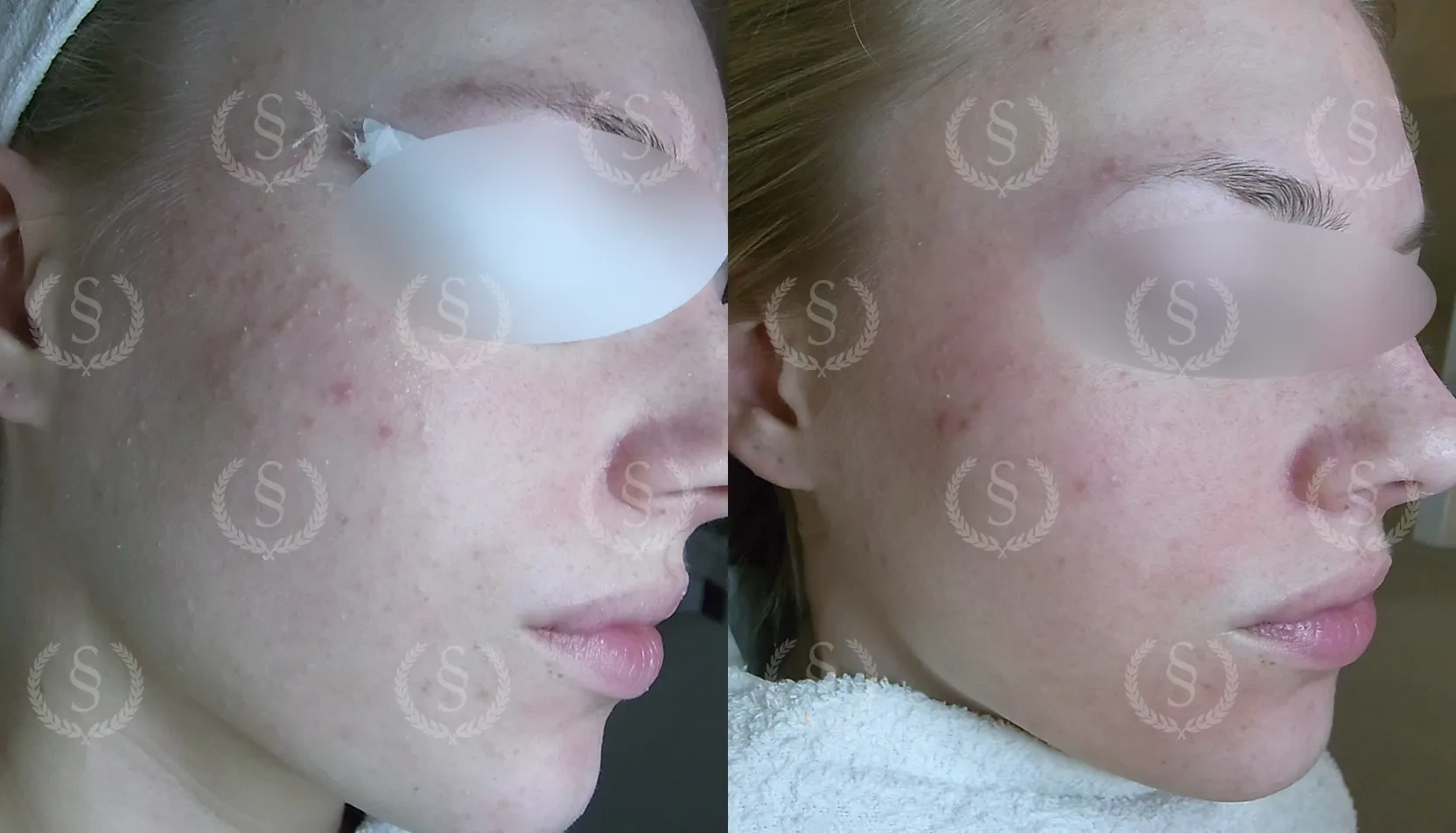 Behandling av porig hy Porig hy med pormaskar före och efter behandling
