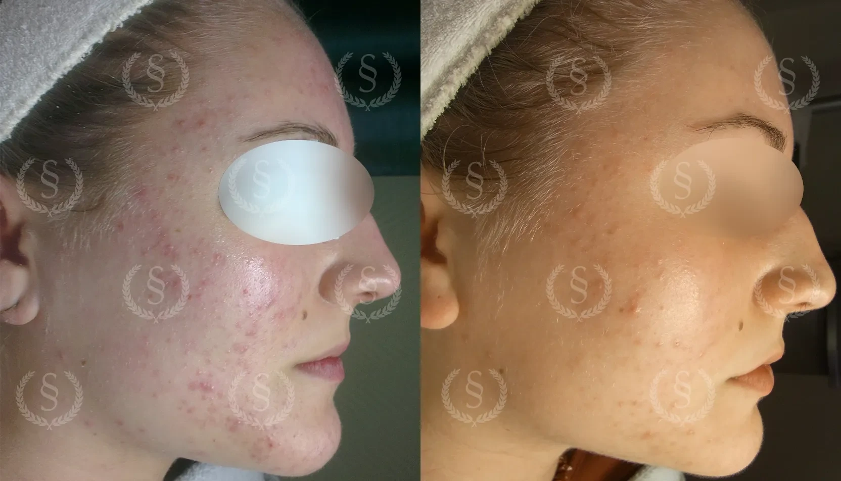 Behandling av röda pormaskar Röda pormaskar i ansiktet före och efter behandling