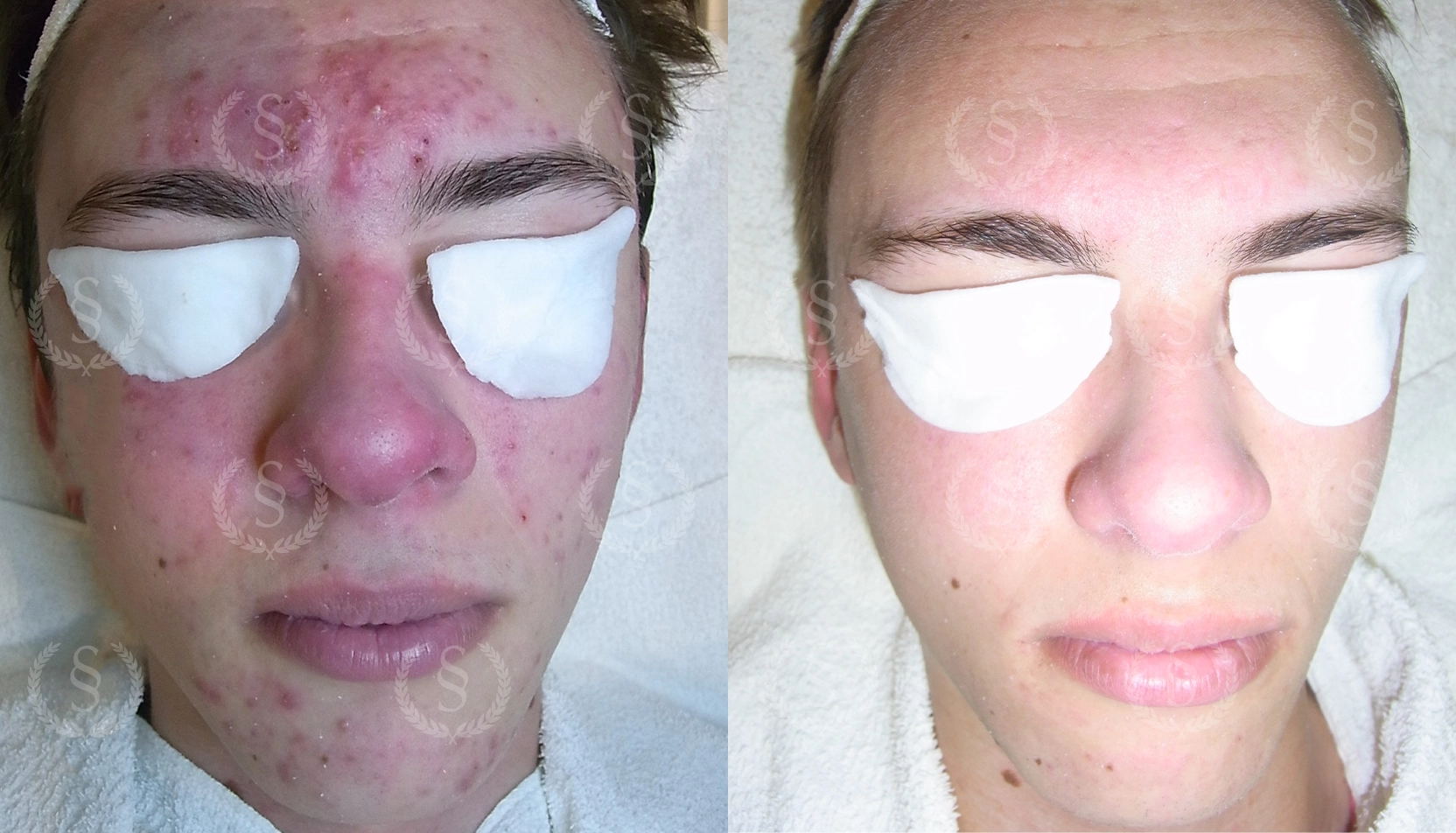 Resultat från behandling av finnar och pormaskar Man med många finnar och pormaskar före och efter behandling