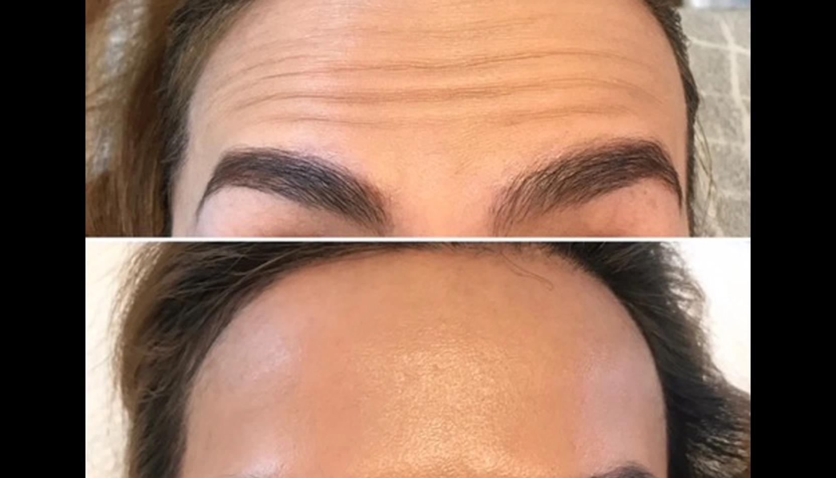Resultat efter volymåterställning med fillers Före och efter fillerbehandling