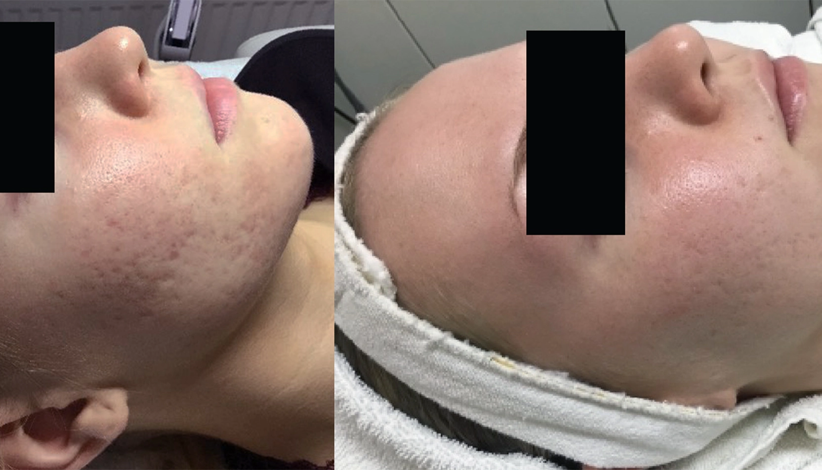 Resultat efter microneedling mot gropar Gropar på kinderna före och efter microneedling