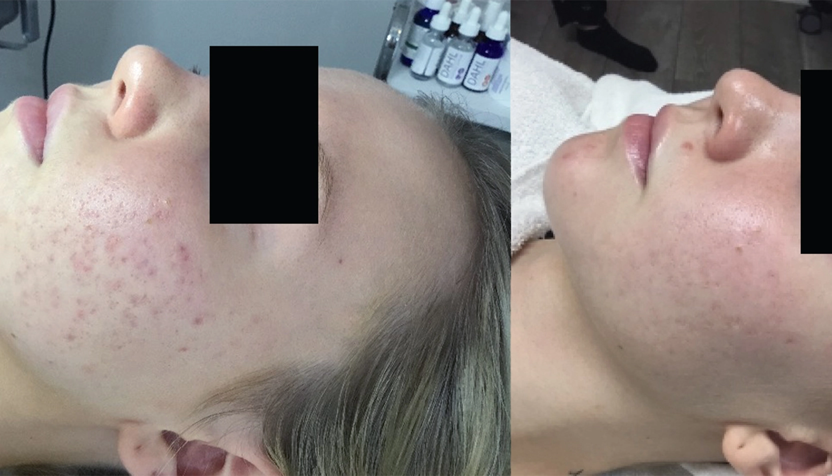 Resultat efter microneedling mot fläckar och gropar Fläckar och gropar på kinderna före och efter microneedling