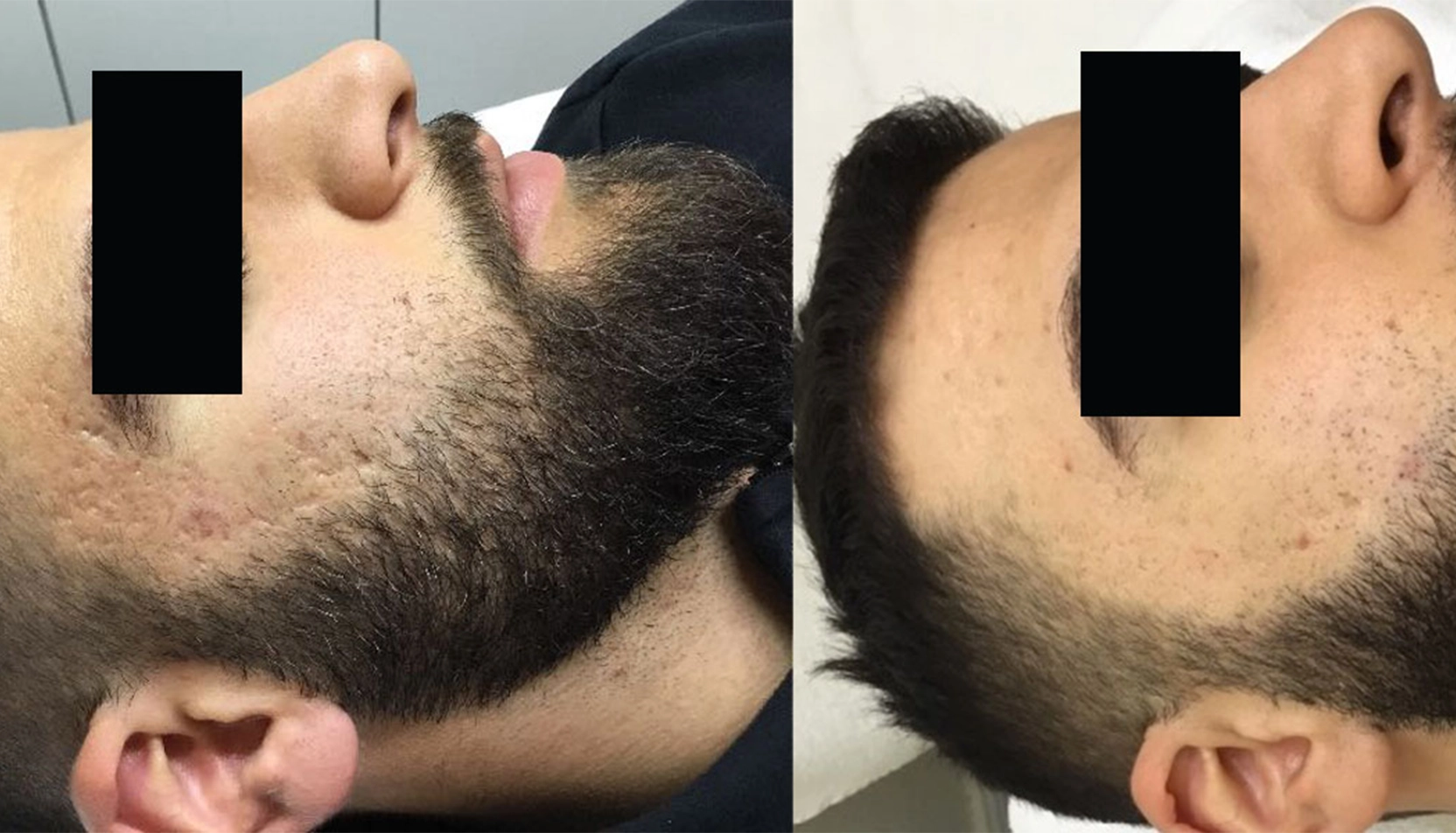 Resultat efter kombinerad behandling mot ärrgropar Gropar på tinningar och kinder före microneedling och CO2-laser