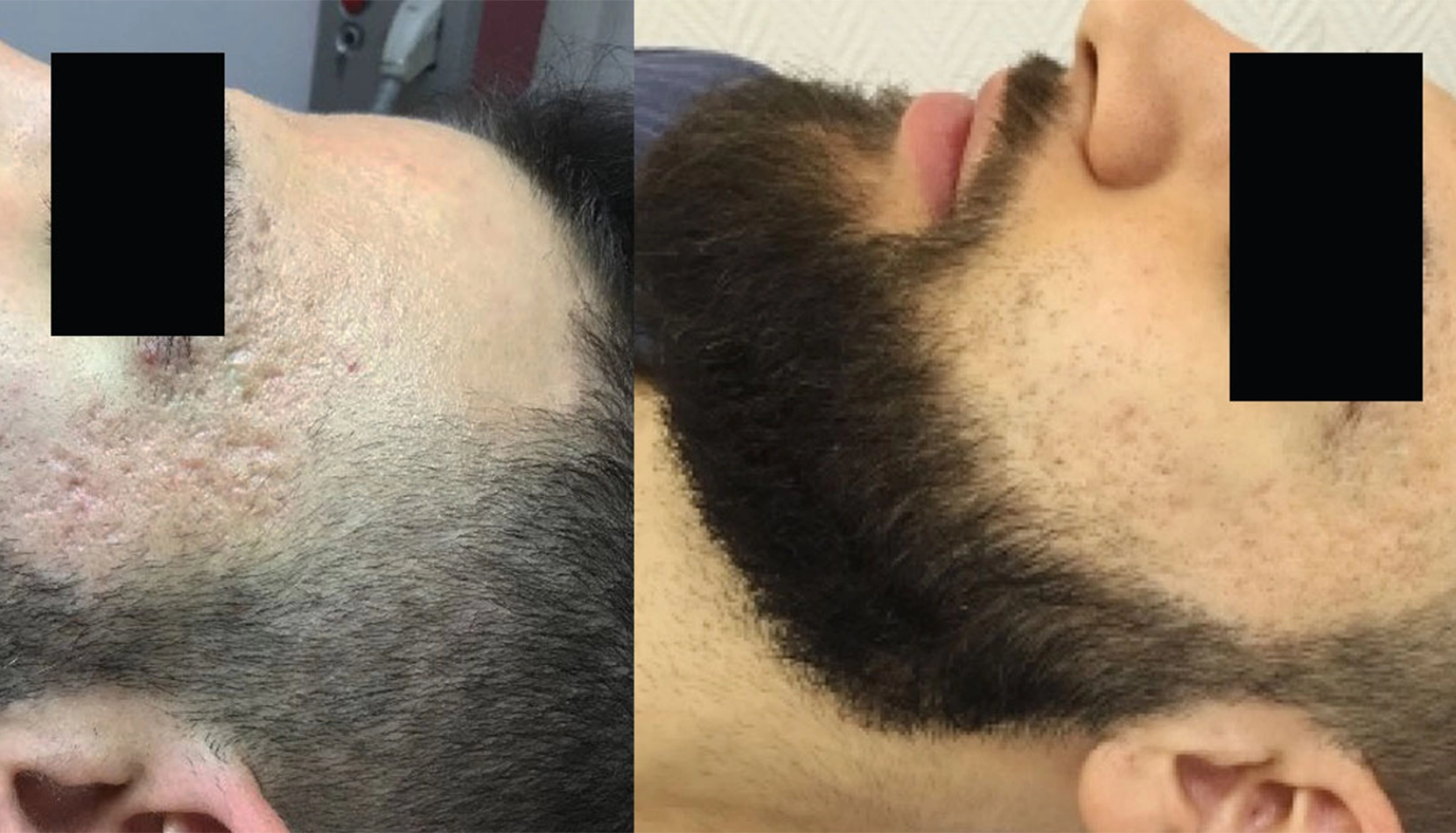 Resultat från andra sidan av ansiktet efter kombinerad behandling Gropar på tinningar och kinder efter microneedling och CO2-laser