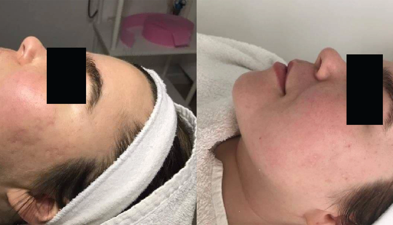 Resultat efter microneedling mot gropar på kinderna Gropar på kinderna behandlade med microneedling