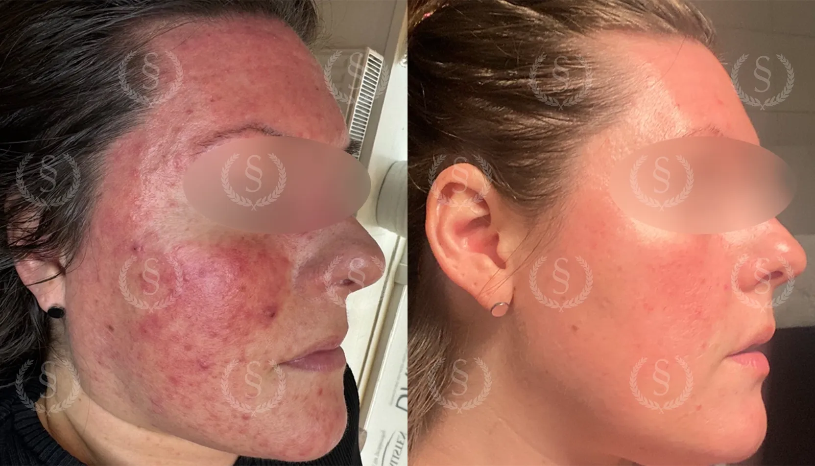 Resultat efter rosacea-behandling höger sida Rosacea i ansiktet från höger sida före och efter behandling