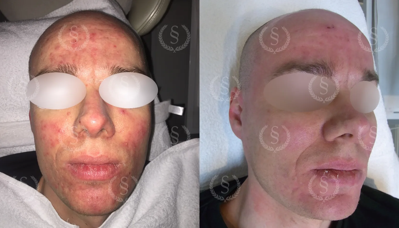 Resultat efter behandling av rosacea med utslag Rosacea med utslag i ansiktet före och efter behandling