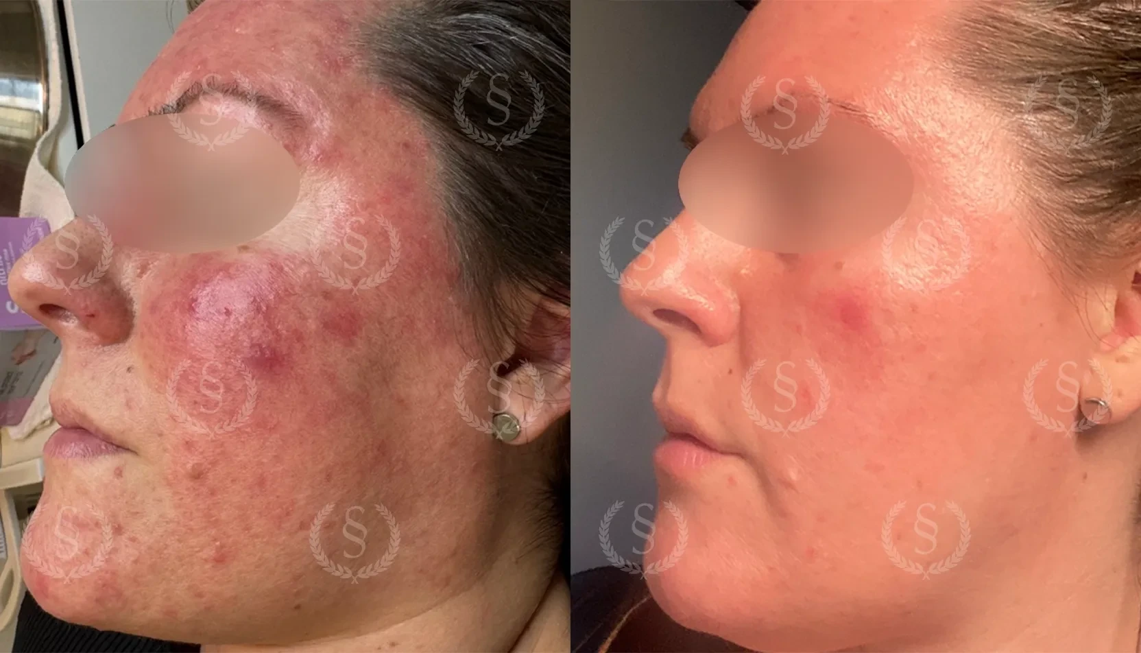 Resultat efter rosacea-behandling vänster sida Rosacea i ansiktet från vänster sida före och efter behandling