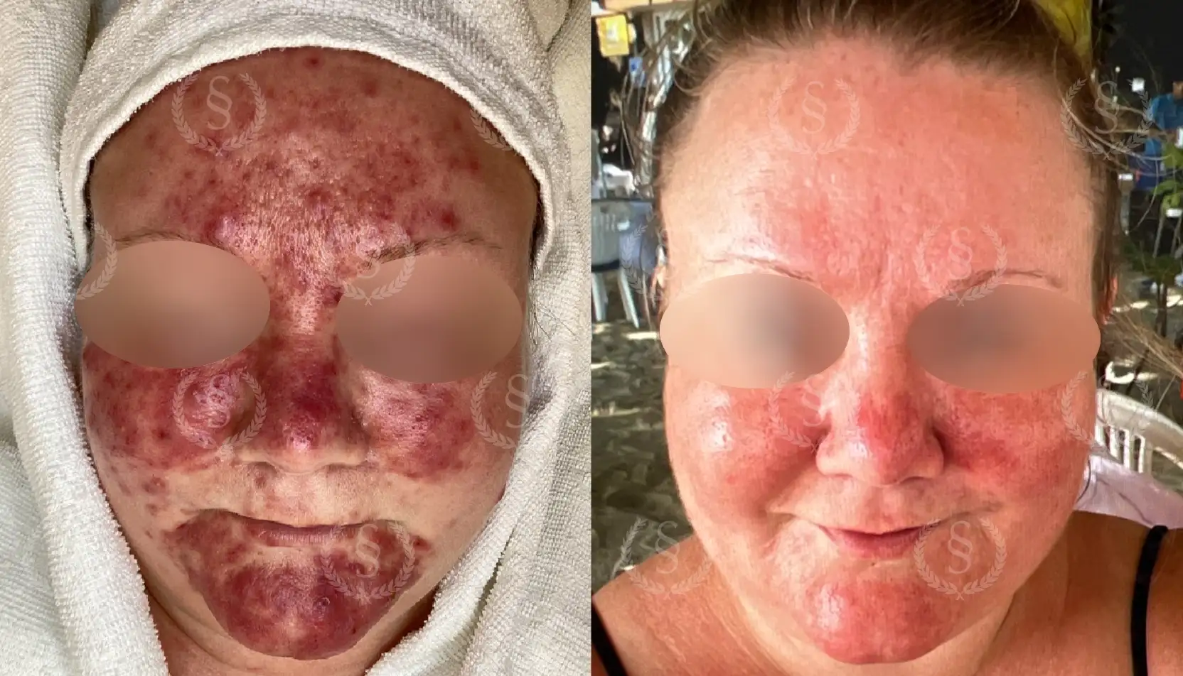 Helansiktsbehandling av rosacea Rosacea över hela ansiktet före och efter behandling
