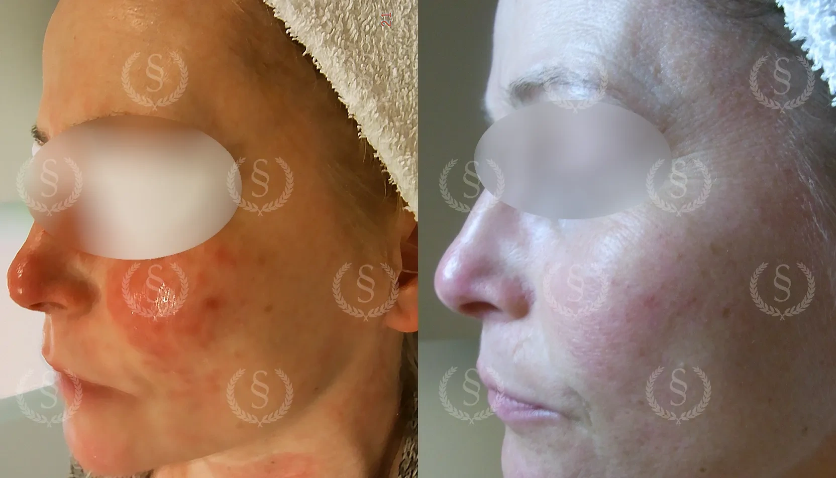 Resultat efter rosacea-behandling på kind Rosacea på kind före och efter behandling