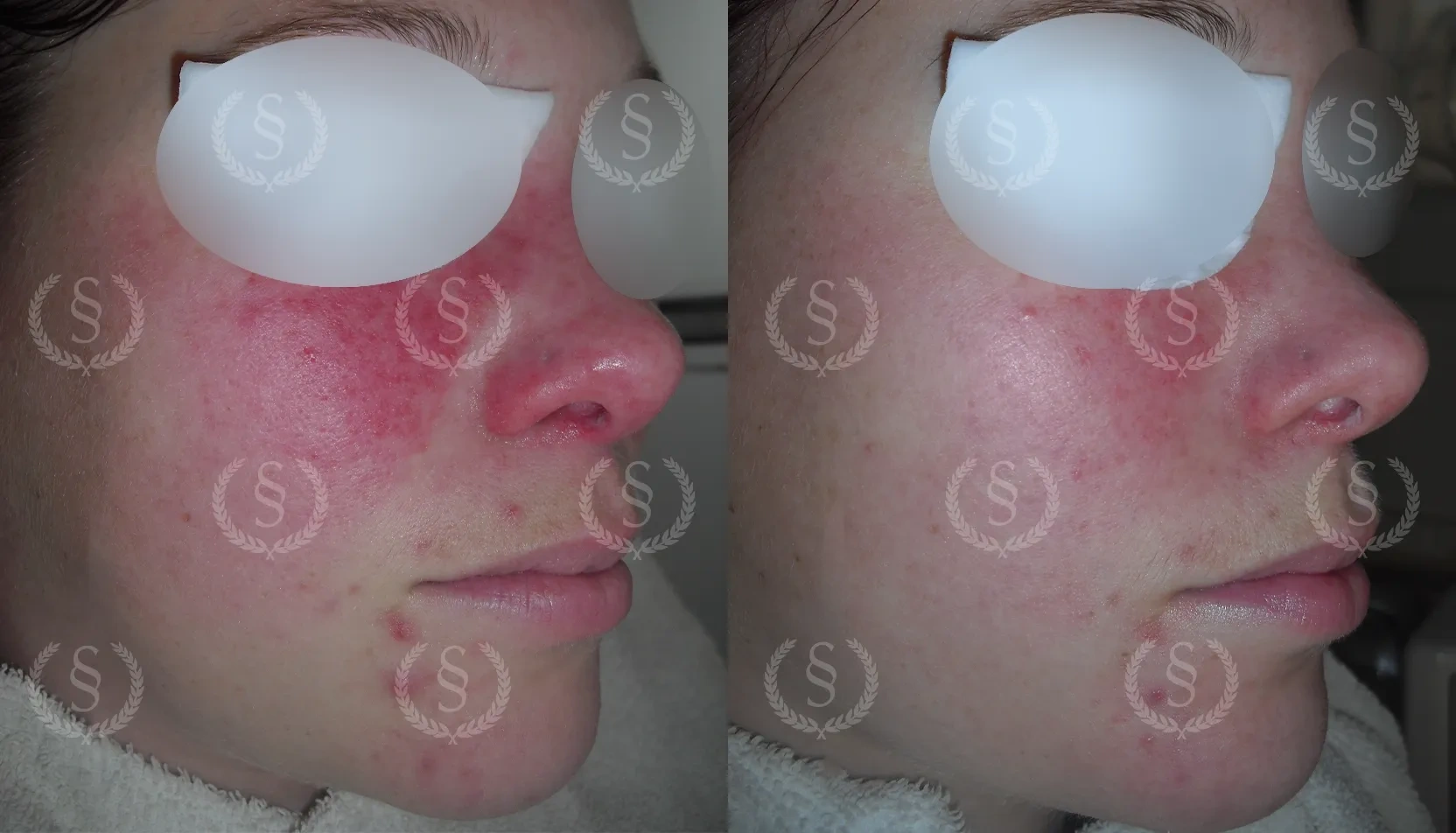 Resultat efter behandling av rosacea med rodnad Rosacea på kinder och näsa med rodnad före och efter behandling