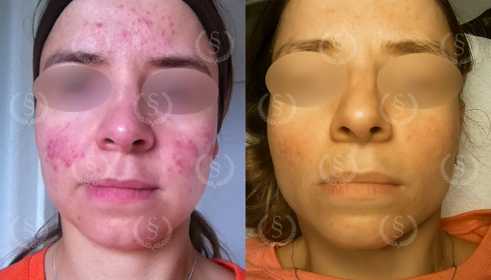 Resultat efter rosacea-behandling på kinder Rosacea på kinder före och efter behandling