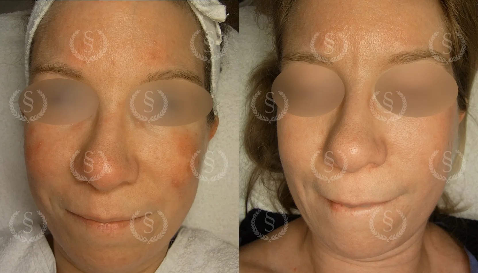 Resultat efter rosacea-behandling på kinderna Rosacea på kinderna före och efter behandling