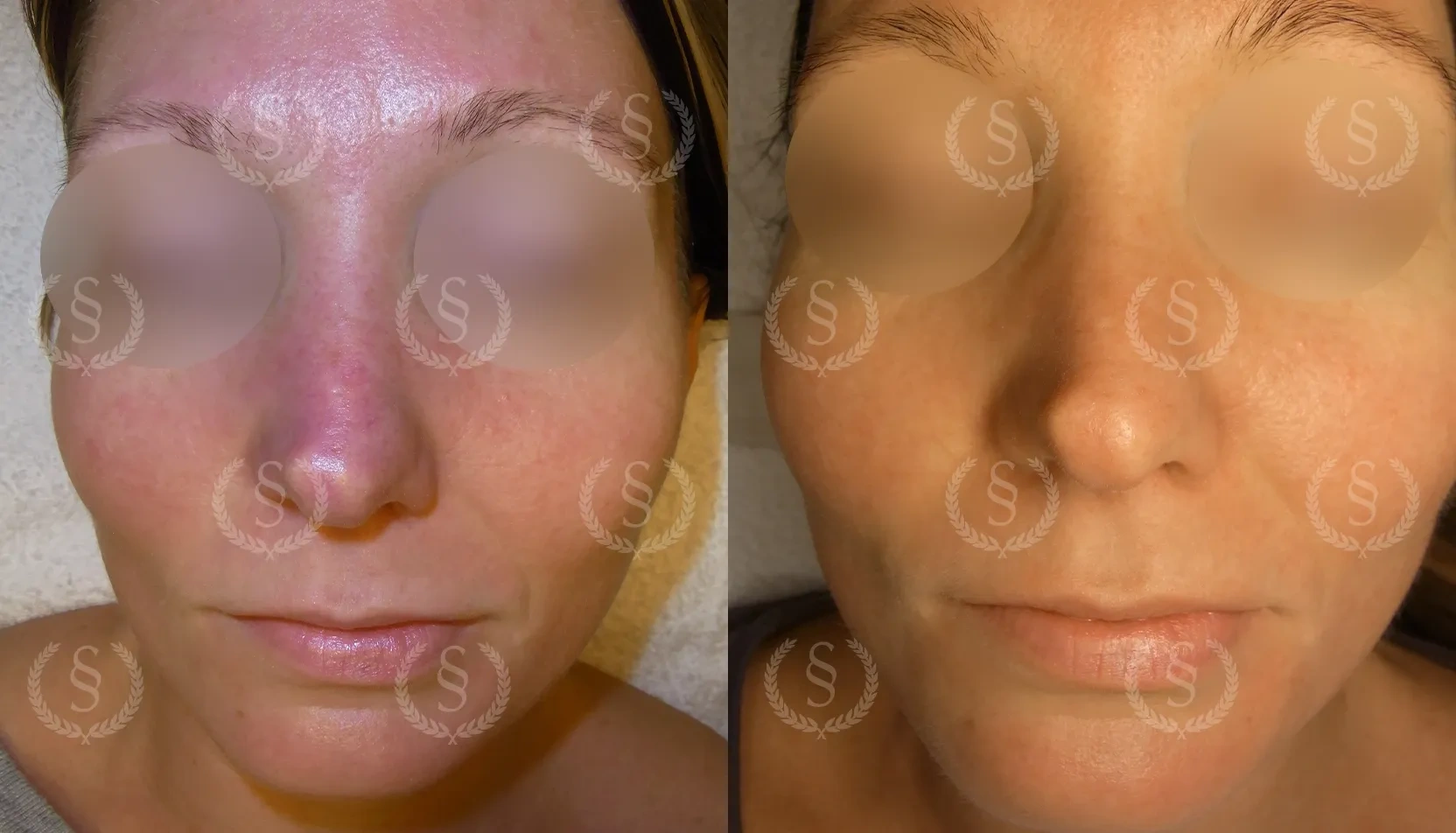 Resultat efter behandling av lätt rosacea Lätt rosacea i ansiktet före och efter behandling