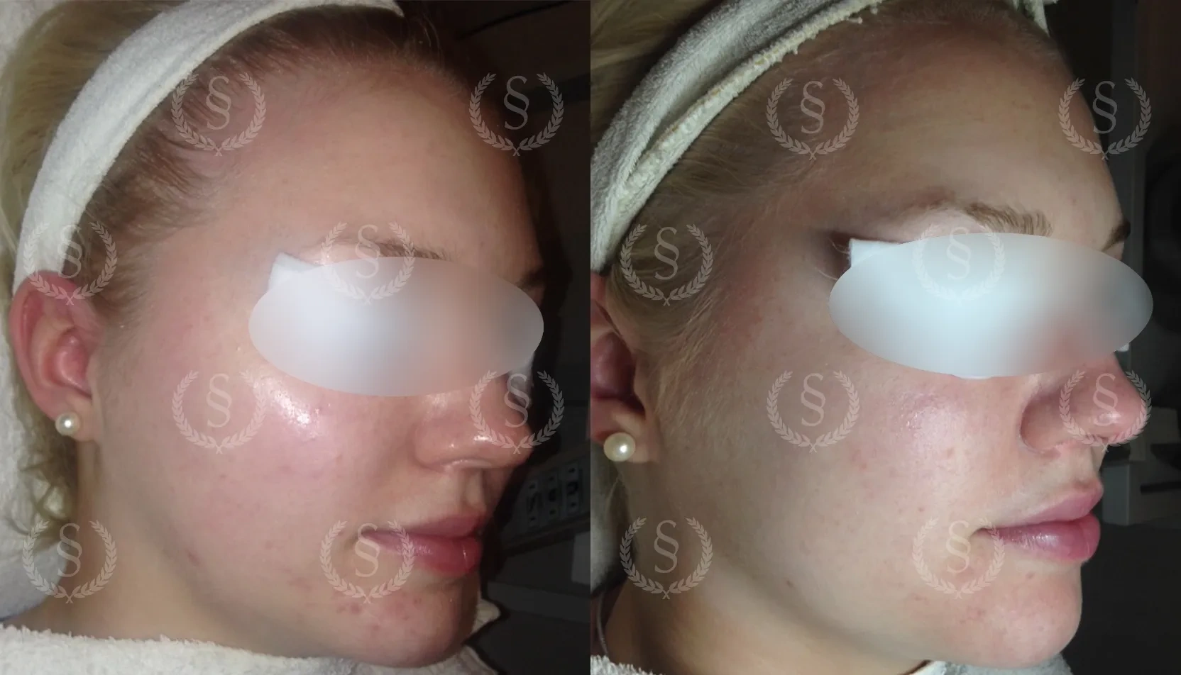 Resultat efter behandling av lätt rosacea på haka Lätt rosacea på hakan före och efter behandling
