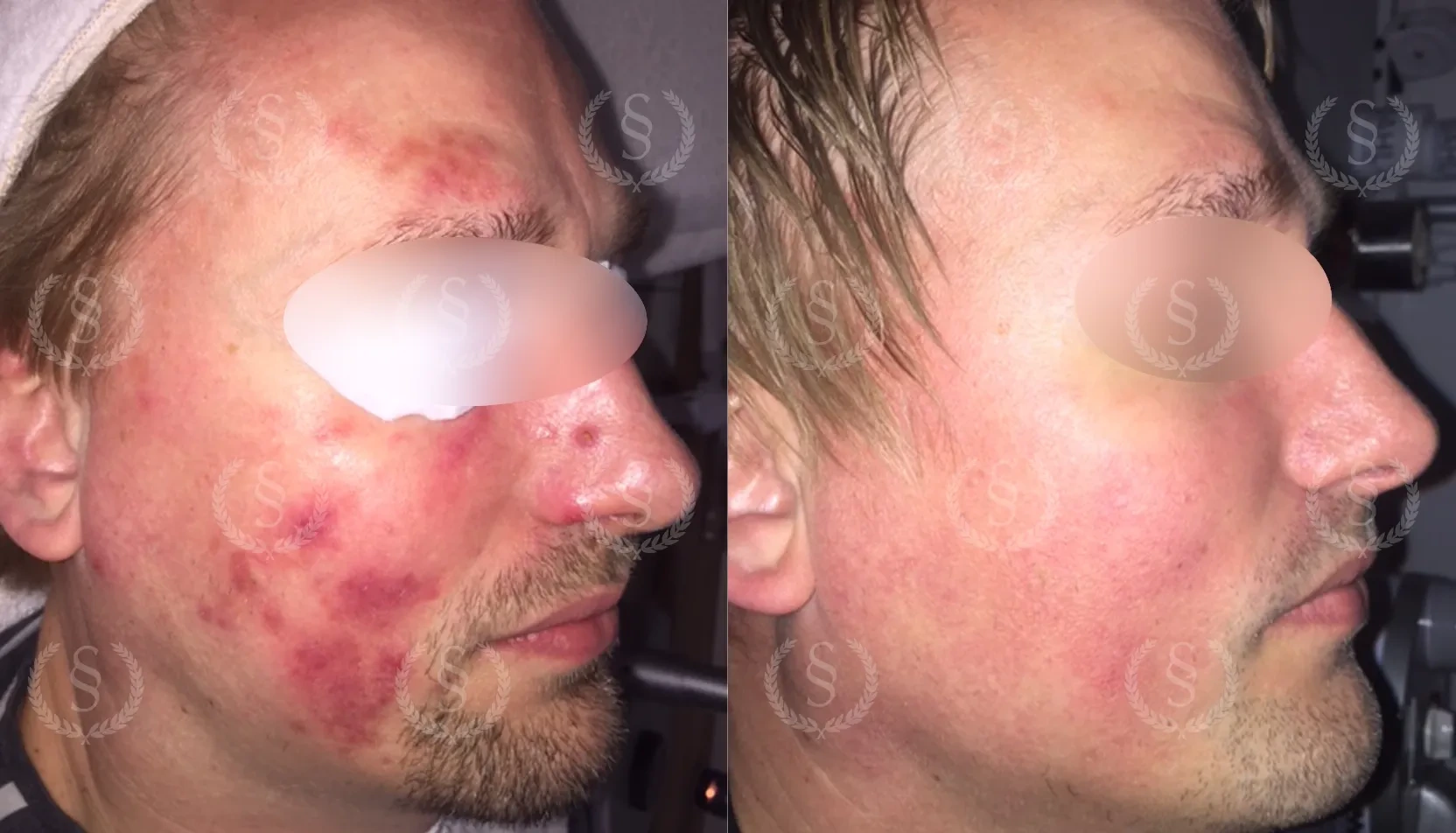 Resultat vid omfattande rosacea Omfattande rosacea i ansiktet före och efter behandling