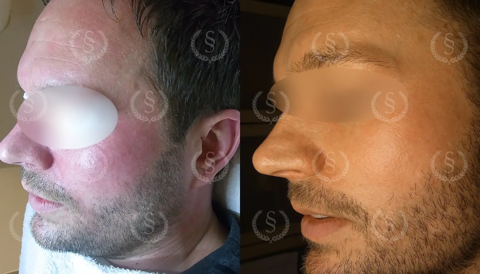 Resultat efter behandling av rosacea på näsa och kinder Rosacea på näsa och kinder före och efter behandling