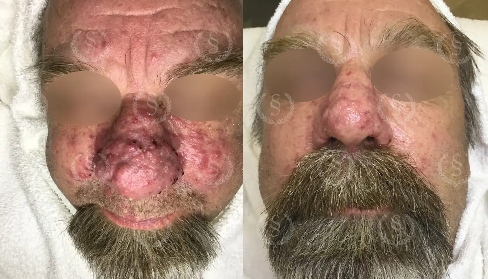 Resultat efter behandling av rosacea på näsan Rosacea på näsan före och efter behandling